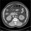 Acute pancreatitis - mild (Radiopaedia 27796-28033 Axial non-contrast 20).jpg