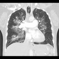 Acute pulmonary edema on CT (Radiopaedia 33582-34672 Coronal lung window 17).jpg