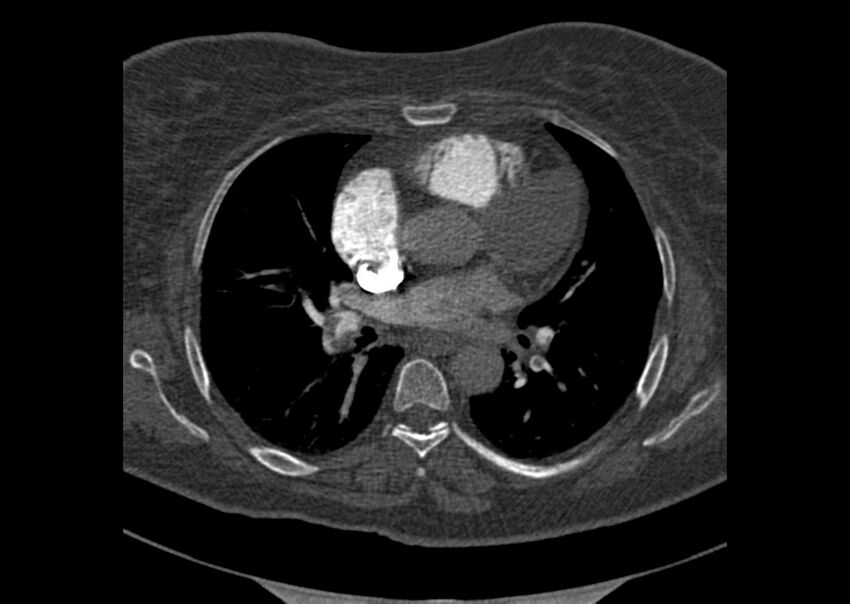 Acute pulmonary embolism (Radiopaedia 29938-30466 Axial C+ CTPA 95).jpg