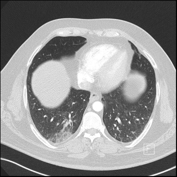 File:Acute pulmonary embolism with pulmonary infarct (Radiopaedia 73062-83768 Axial lung window 13).jpg