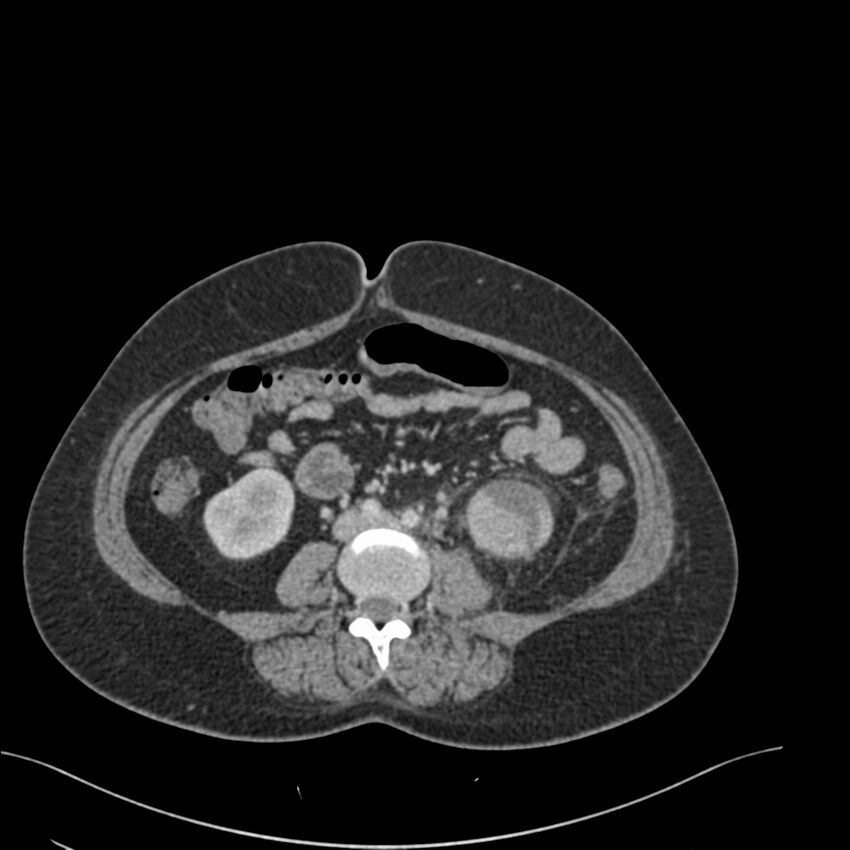 Acute pyelonephritis with renal vein thrombosis (Radiopaedia 58020-65053 Axial renal parenchymal phase 121).jpg