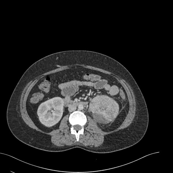 File:Acute pyelonephritis with renal vein thrombosis (Radiopaedia 58020-65053 Axial renal parenchymal phase 90).jpg