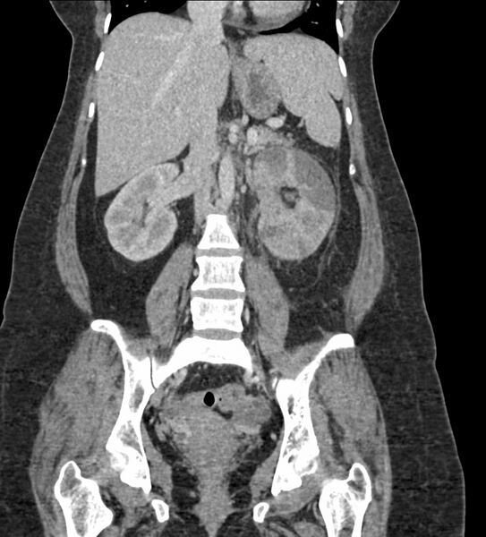 File:Acute pyelonephritis with renal vein thrombosis (Radiopaedia 58020-65053 Coronal renal parenchymal phase 52).jpg