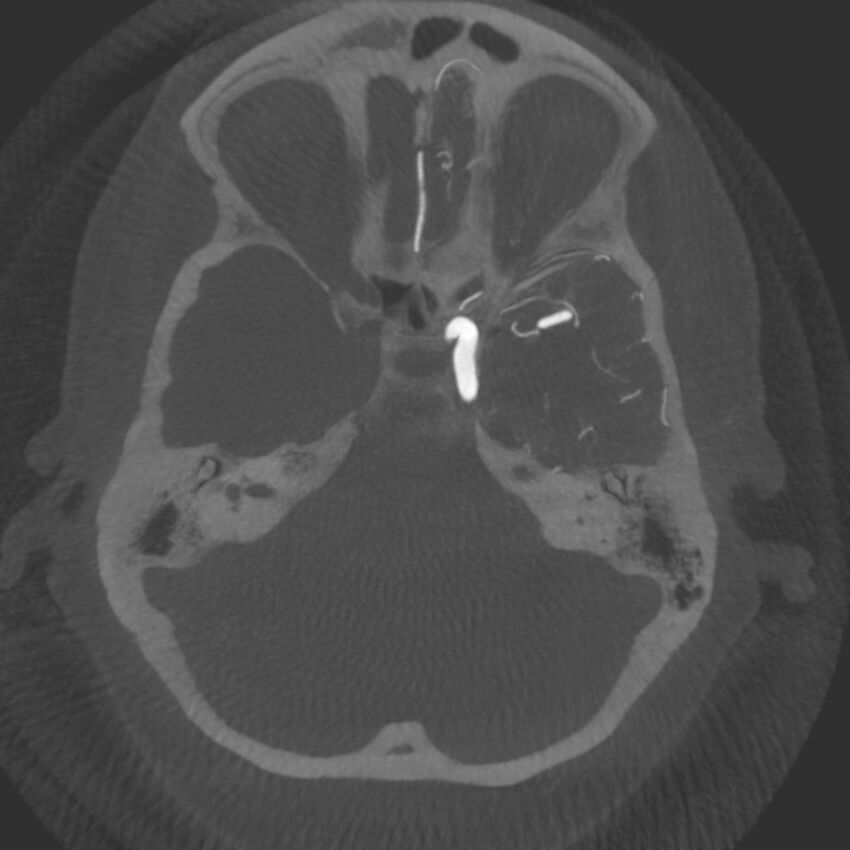 Acute subarachnoid hemorrhage and accessory anterior cerebral artery (Radiopaedia 69231-79010 C 15).jpg
