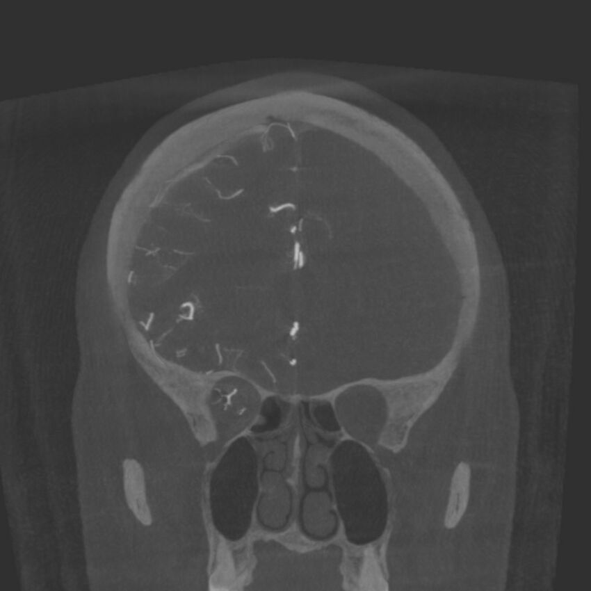 Acute subarachnoid hemorrhage and accessory anterior cerebral artery (Radiopaedia 69231-79010 Coronal arterial - MIP 29).jpg