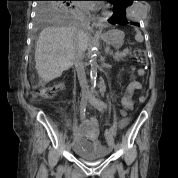 File:Acute tubular necrosis (Radiopaedia 28077-28334 G 46).jpg