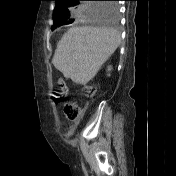 File:Acute tubular necrosis (Radiopaedia 28077-28334 H 22).jpg