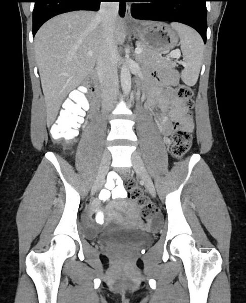 File:Acute uncomplicated appendicitis (Radiopaedia 61374-69304 Coronal C+ portal venous phase 55).jpg