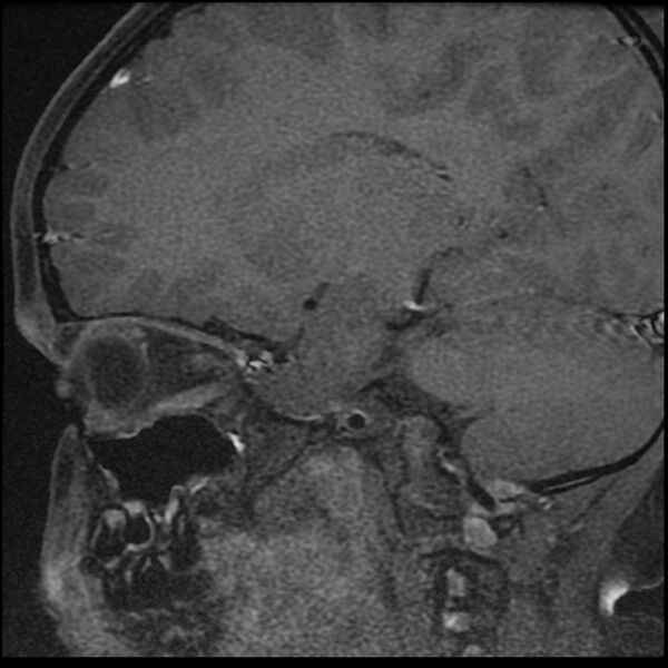 File:Adamantinomatous craniopharyngioma (Radiopaedia 77407-89529 Sagittal T1 C+ fat sat 2).jpg