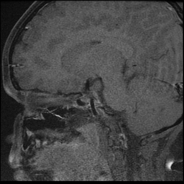 File:Adamantinomatous craniopharyngioma (Radiopaedia 77407-89529 Sagittal T1 C+ fat sat 4).jpg