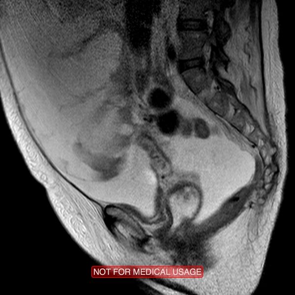 File:Adenocarcinoma of the cervix (Radiopaedia 28373-28615 Sagittal T2 5).jpg