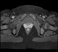 Adenomyosis - ovarian endometriomas (Radiopaedia 67031-76350 Axial T1 C+ fat sat 24).jpg