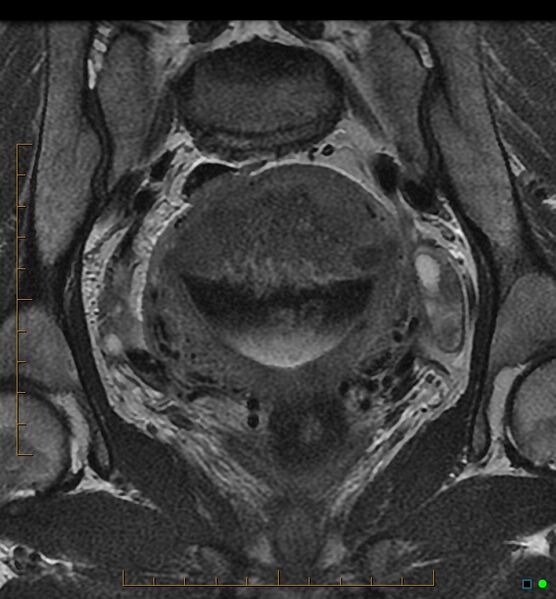 File:Adenomyosis uterus with hematometra (Radiopaedia 45779-50011 Coronal T2 11).jpg