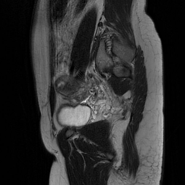 File:Adenomyosis within a septate uterus (Radiopaedia 69963-79981 Sagittal T2 24).jpg