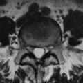 Adhesive arachnoiditis - empty thecal sac sign (Radiopaedia 25838-25987 Axial T2 5).jpg