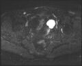 Adnexal multilocular cyst (O-RADS US 3- O-RADS MRI 3) (Radiopaedia 87426-103754 Axial DWI 15).jpg