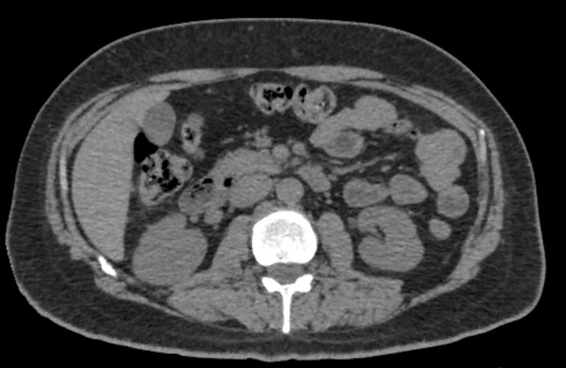 File:Adrenal myelolipoma (Radiopaedia 65240-74253 Axial non-contrast 63).jpg