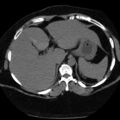 Adrenal myelolipoma (Radiopaedia 8216-9068 B 6).jpg
