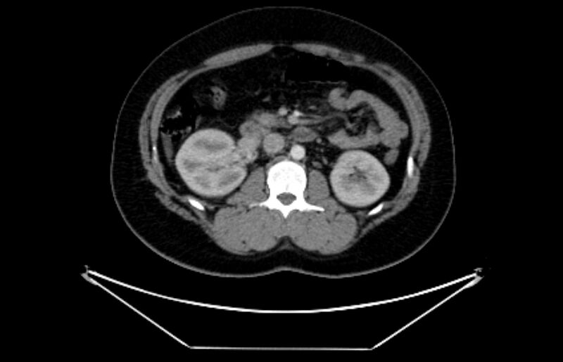 File:Adrenocortical carcinoma (Radiopaedia 80134-93438 Axial C+ portal venous phase 59).jpg