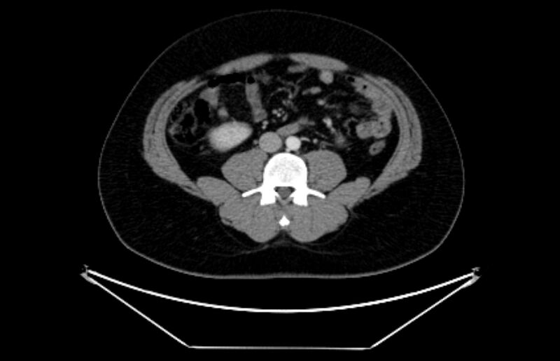File:Adrenocortical carcinoma (Radiopaedia 80134-93438 Axial C+ portal venous phase 76).jpg