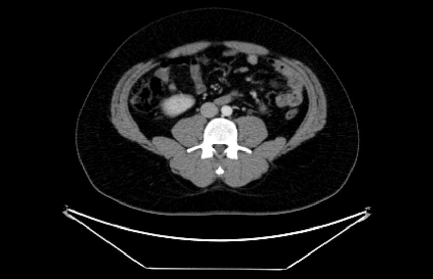 Adrenocortical carcinoma (Radiopaedia 80134-93438 Axial C+ portal venous phase 76).jpg