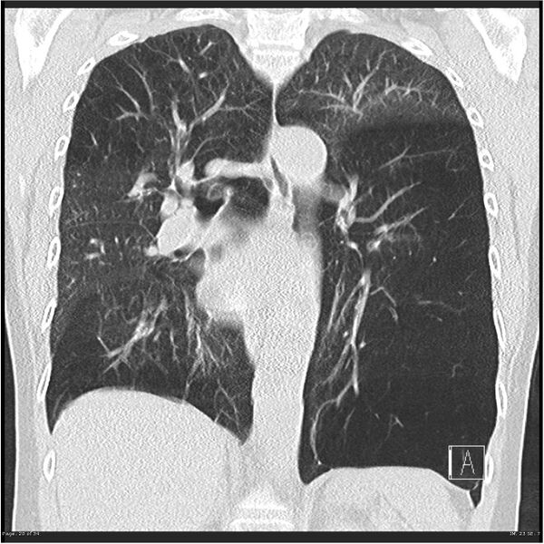 File:Alpha-1-antitrypsin deficiency (Radiopaedia 26537-26678 Coronal lung window 20).jpg