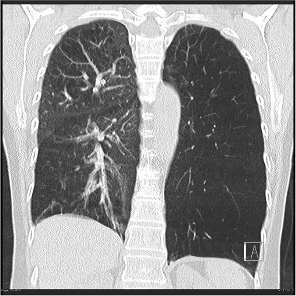 File:Alpha-1-antitrypsin deficiency (Radiopaedia 26537-26678 Coronal lung window 24).jpg