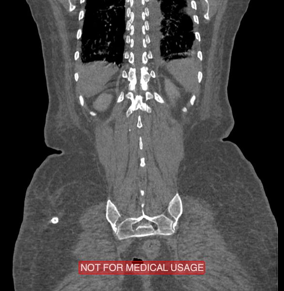 File:Amoebic enterocolitis with liver abscess (Radiopaedia 35100-36609 B 178).jpg