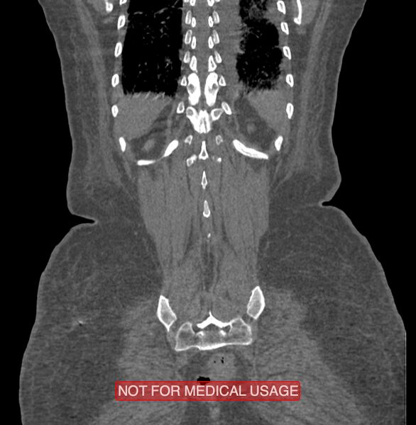 File:Amoebic enterocolitis with liver abscess (Radiopaedia 35100-36609 B 182).jpg