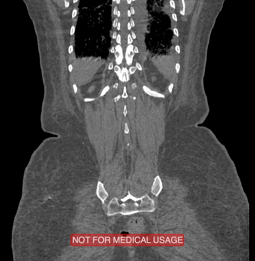 Amoebic enterocolitis with liver abscess (Radiopaedia 35100-36609 B 182).jpg