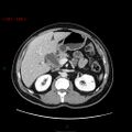 Ampullary carcinoma (Radiopaedia 56396-63056 C 34).jpg