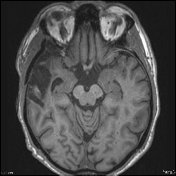 File:Anaplastic meningioma with recurrence (Radiopaedia 34452-35788 Axial T1 51).jpg