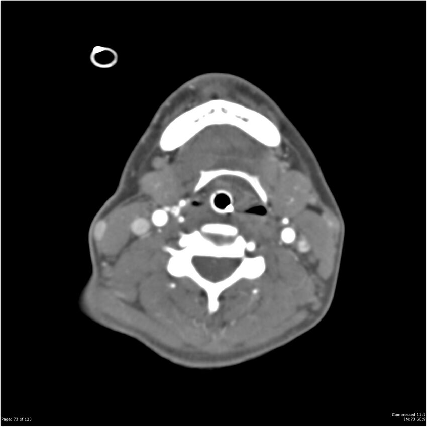 Aneurysmal subarachnoid hemorrhage and Moya Moya disease (Radiopaedia 34306-35593 Axial CT COW 73).jpg