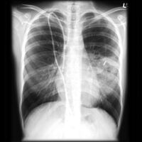 Chest X-ray: Angioinvasive aspergillosis