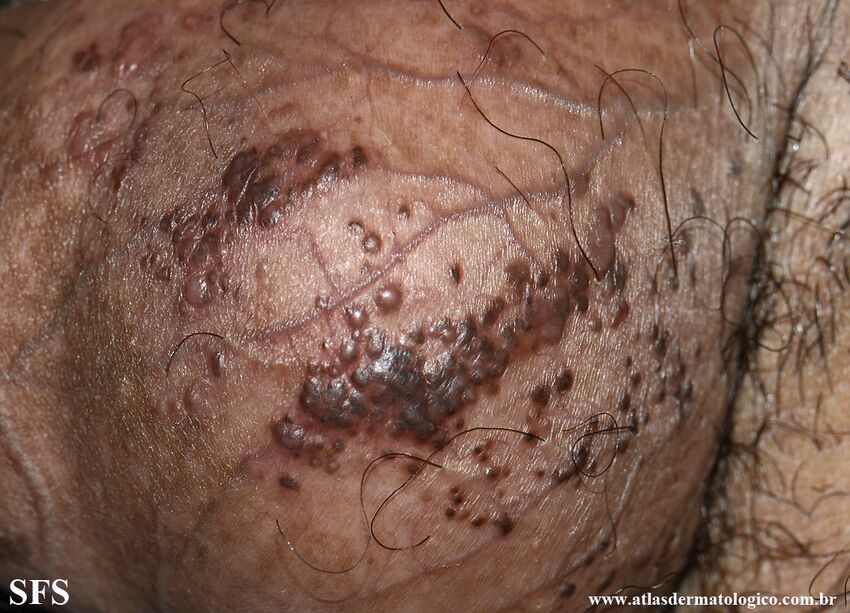 Angiokeratoma Of The Scrotum (Dermatology Atlas 16).jpg