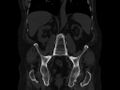 Ankylosing spondylitis (Radiopaedia 44609-48357 Coronal bone window 48).jpg