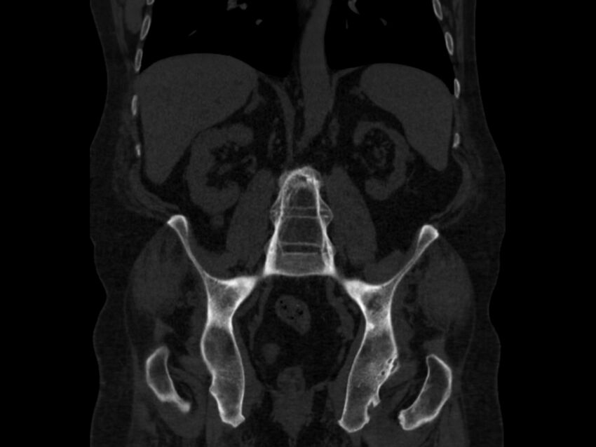 Ankylosing spondylitis (Radiopaedia 44609-48357 Coronal bone window 48).jpg