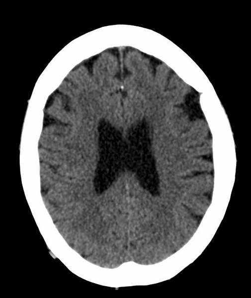File:Anomalous intracranial venous drainage (Radiopaedia 28161-28418 Axial 30).png