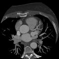 Anomalous origin of left circumflex artery from right coronary sinus (Radiopaedia 72563-83117 A 45).jpg