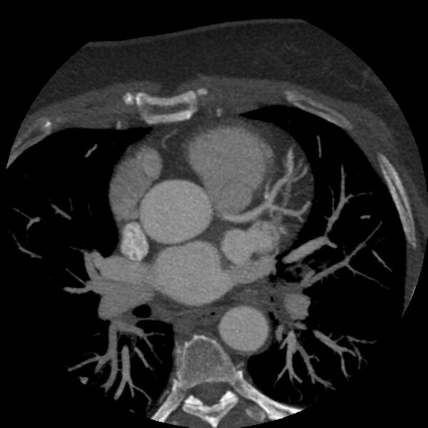 File:Anomalous origin of left circumflex artery from right coronary sinus (Radiopaedia 72563-83117 A 45).jpg