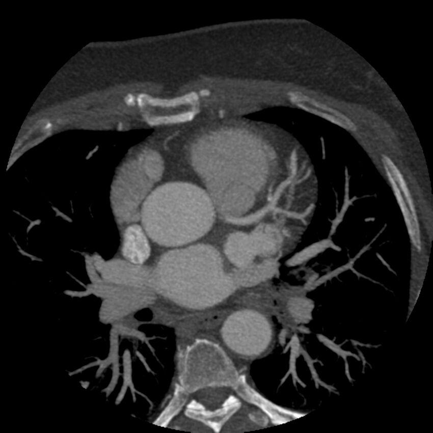 Anomalous origin of left circumflex artery from right coronary sinus (Radiopaedia 72563-83117 A 45).jpg