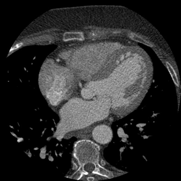 File:Anomalous origin of left circumflex artery from right coronary sinus (Radiopaedia 72563-83117 B 83).jpg