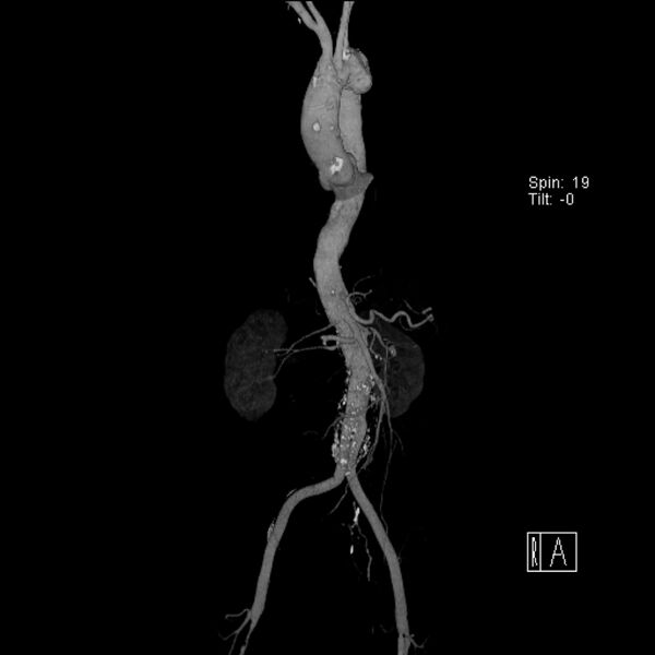 File:Aortic arch saccular aneurysm (Radiopaedia 19430-19457 A 18).jpg