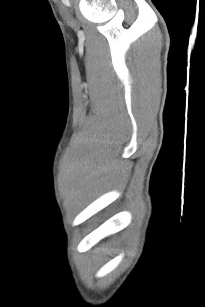 File:Aortic coarctation with aneurysm (Radiopaedia 74818-85828 B 14).jpg