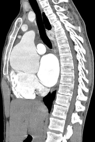 File:Aortic coarctation with aneurysm (Radiopaedia 74818-85828 B 80).jpg