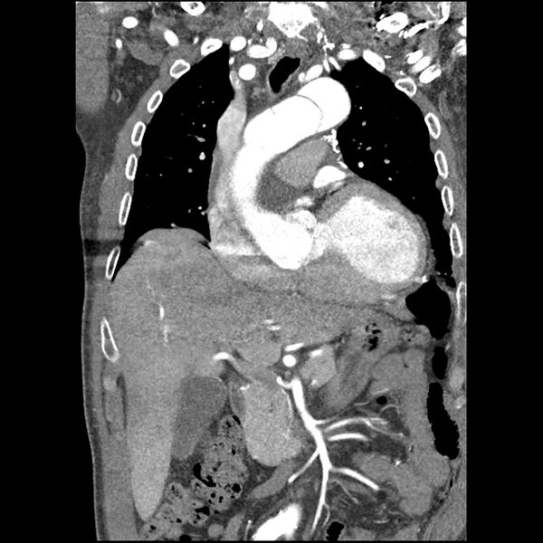 File:Aortic dissection - DeBakey Type I-Stanford A (Radiopaedia 79863-93115 B 15).jpg