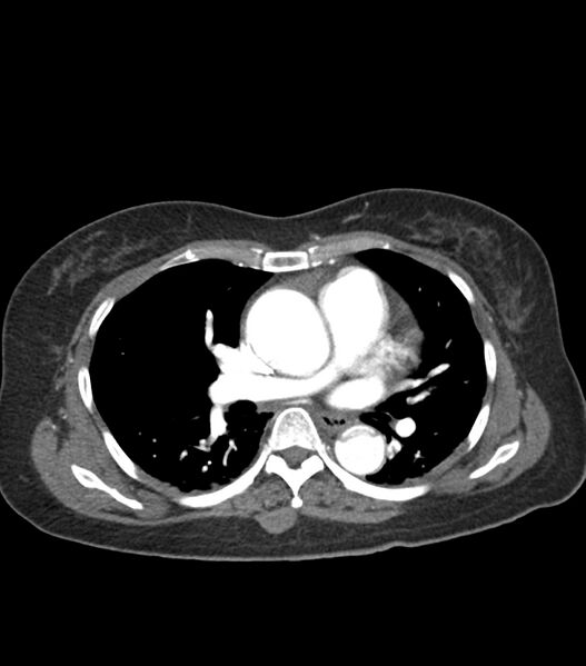 File:Aortic dissection with renal ischemia (Radiopaedia 76573-88338 A 31).jpg