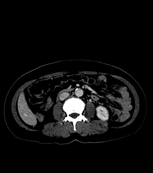 File:Aortic dissection with renal ischemia (Radiopaedia 76573-88338 B 43).jpg