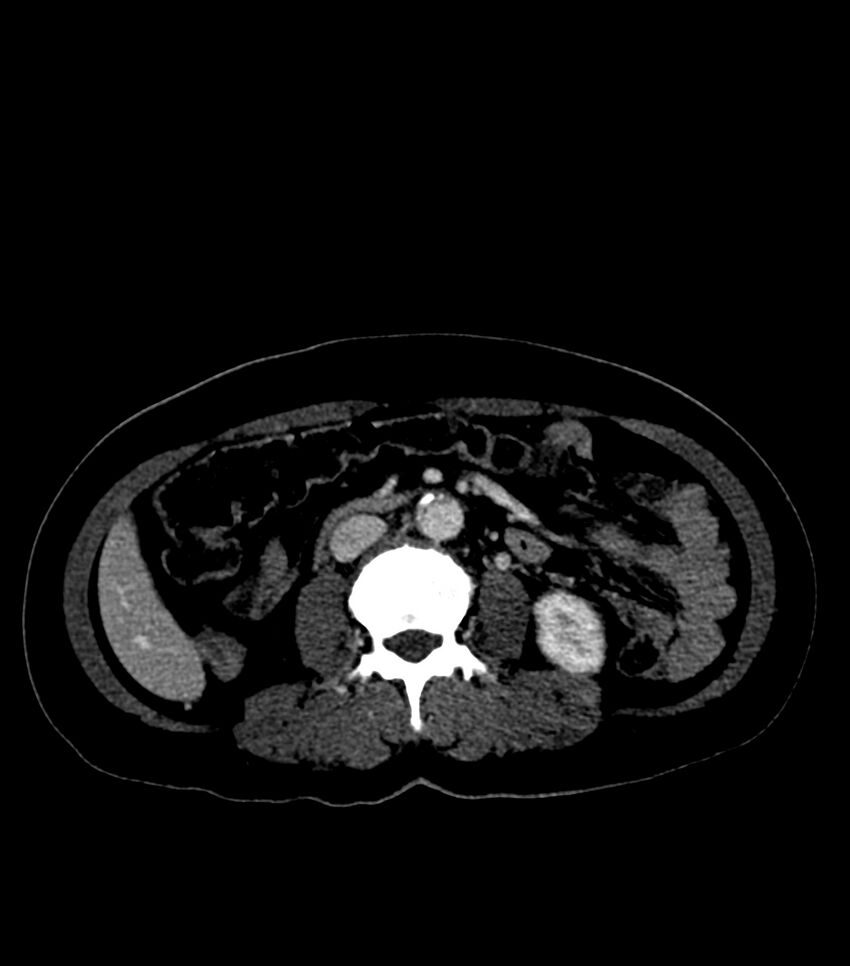 Aortic dissection with renal ischemia (Radiopaedia 76573-88338 B 43).jpg