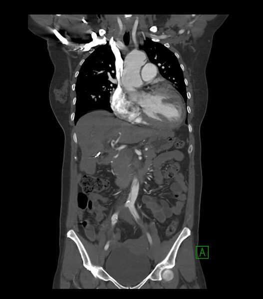 File:Aortic dissection with renal ischemia (Radiopaedia 76573-88338 C 7).jpg